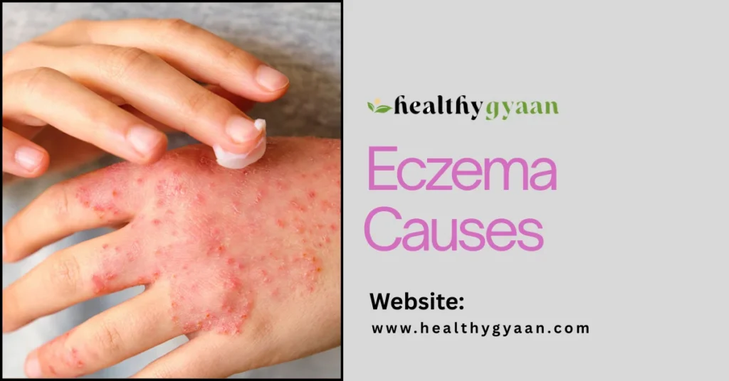 Eczema Causes