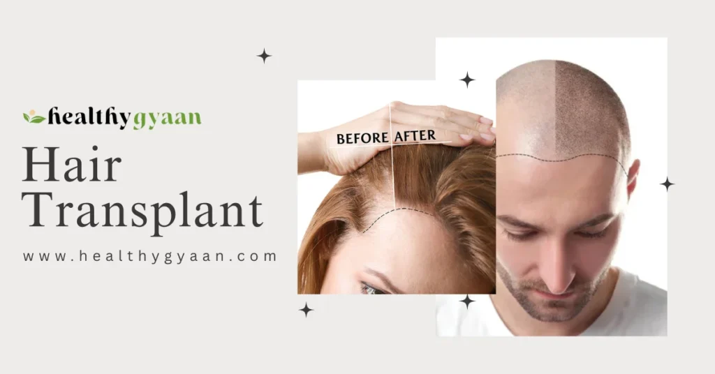 Hair Transplant