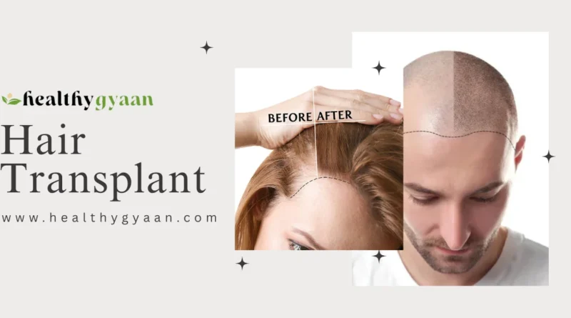 Hair Transplant