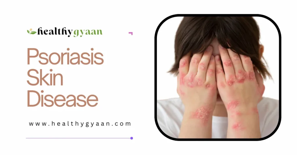 Psoriasis Skin Disease