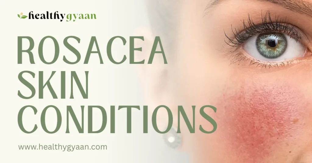 Rosacea Skin Conditions