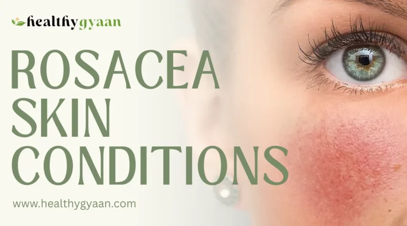Rosacea Skin Conditions