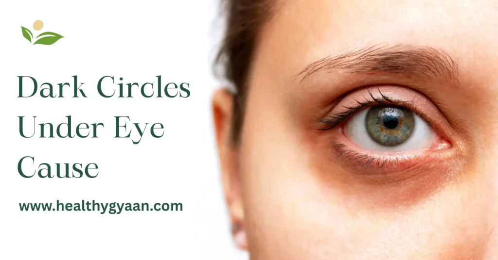 Dark circles under eye cause