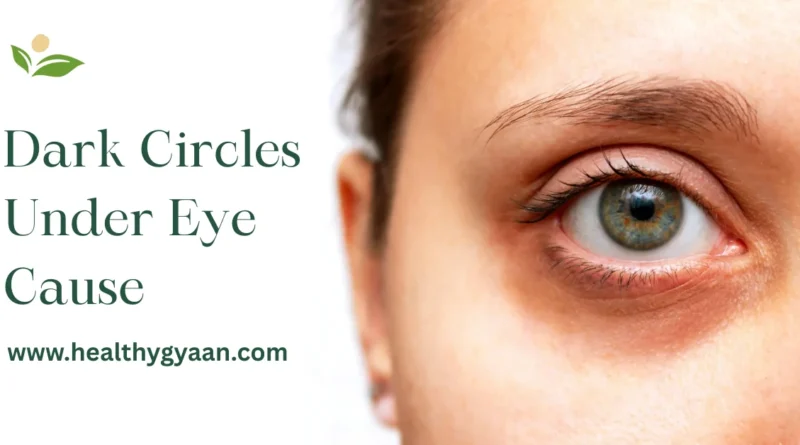 Dark circles under eye cause
