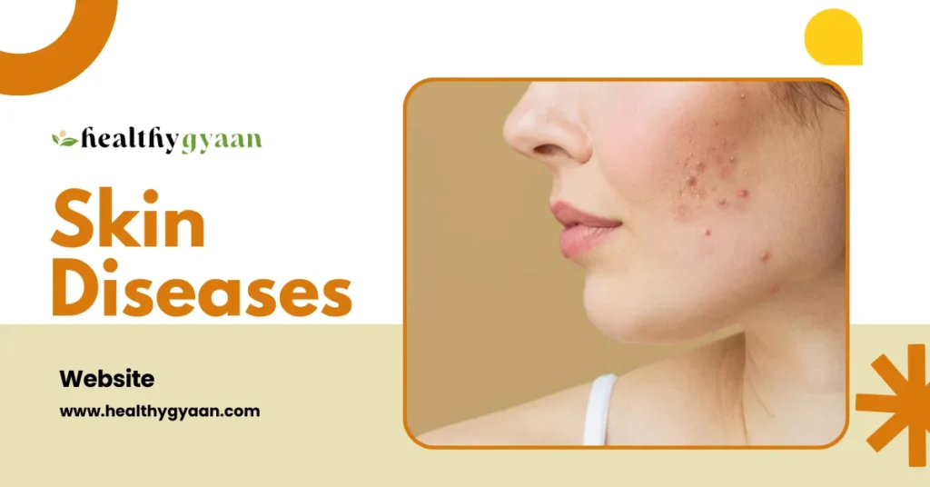 skin diseases