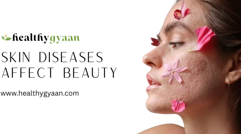 ​Skin Diseases Affect Beauty