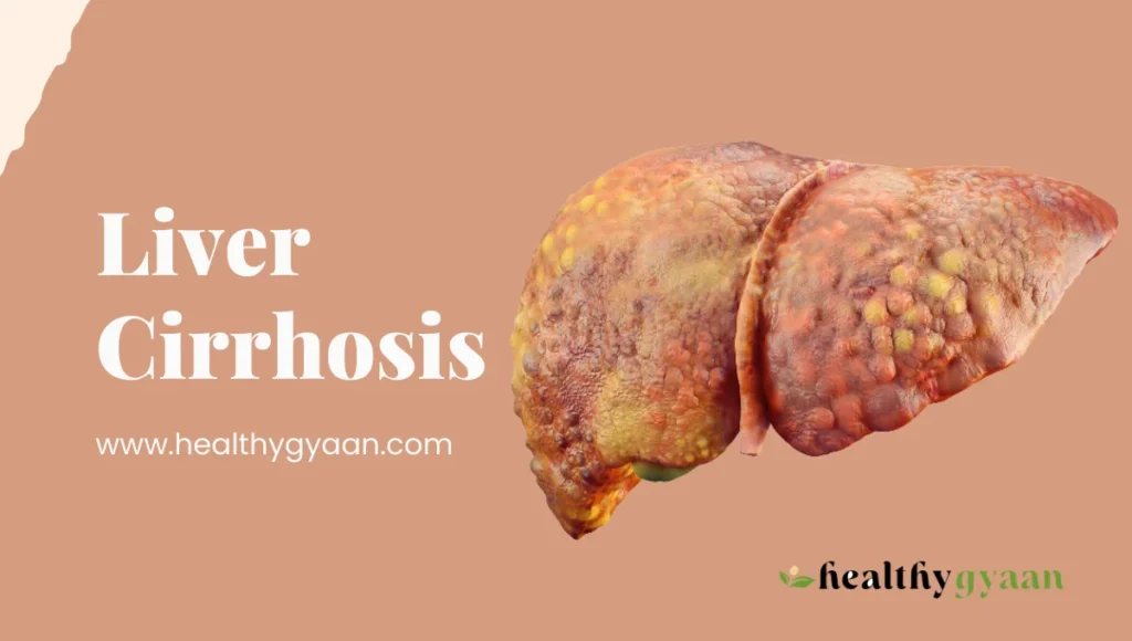 Liver Cirrhosis
