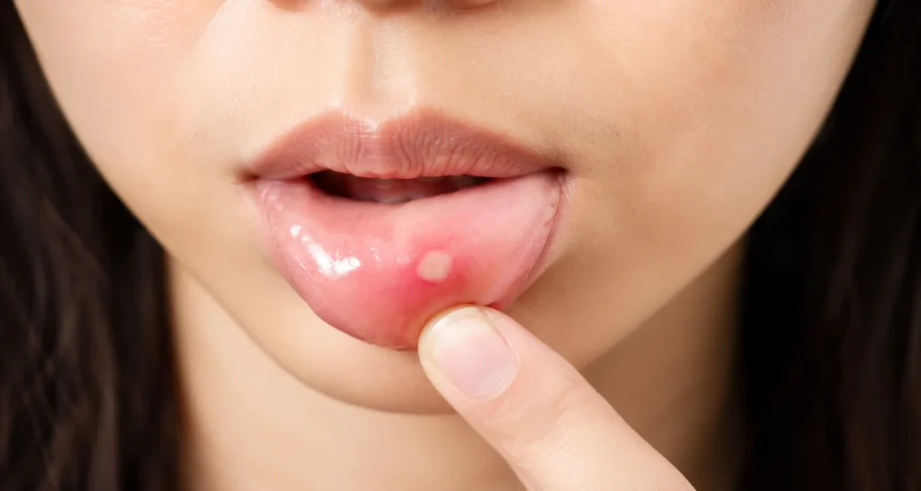Aphthous ulcer or canker sore