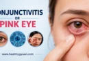 Conjunctivitis or pink eye